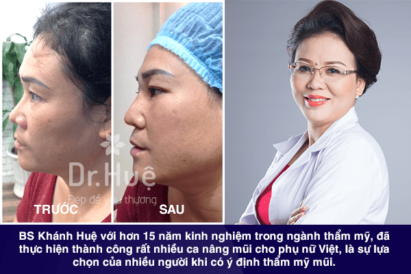 Dr. Huệ - bác sĩ sửa mũi đẹp nhất Sài Gòn