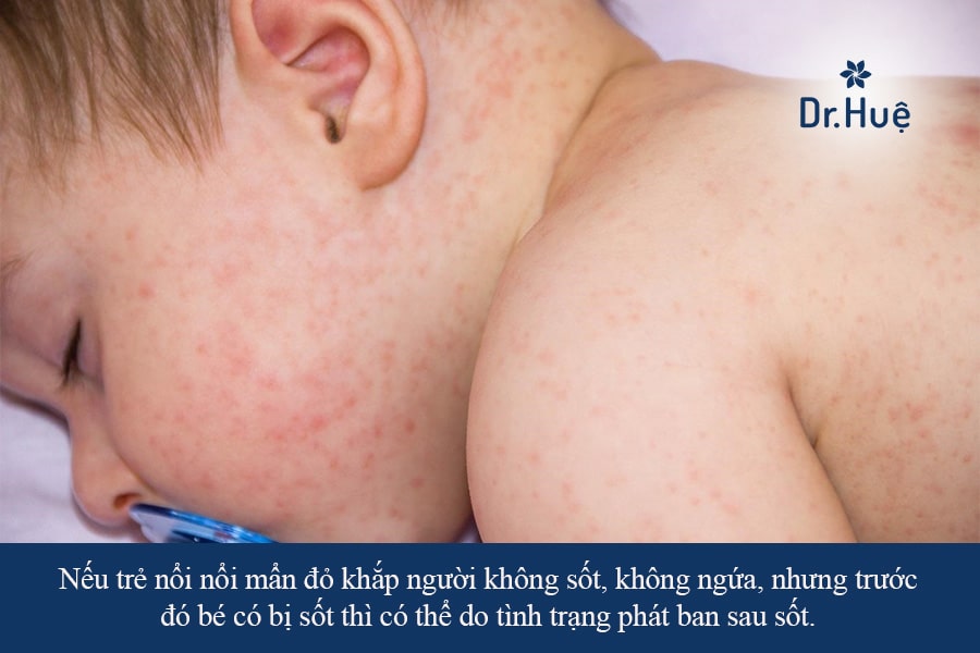 Nguyên nhân gây ra tình trạng trẻ bị nổi mẩn đỏ khắp người không sốt không ngứa?