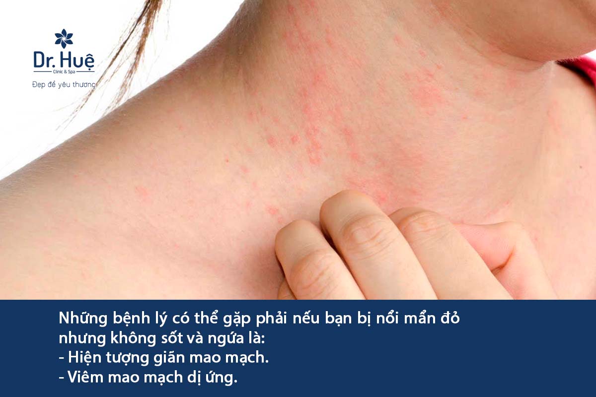 Xuất hiện nhiều vết đốm đỏ trên da không ngứa ở người lớn