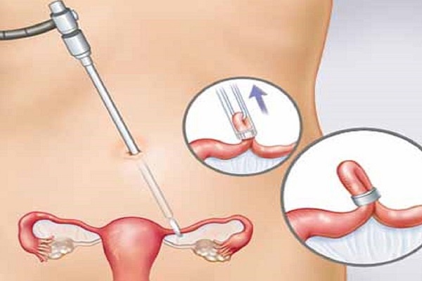 Biện pháp tránh thai tốt nhất dành cho nam giới - thắt ống dẫn tinh