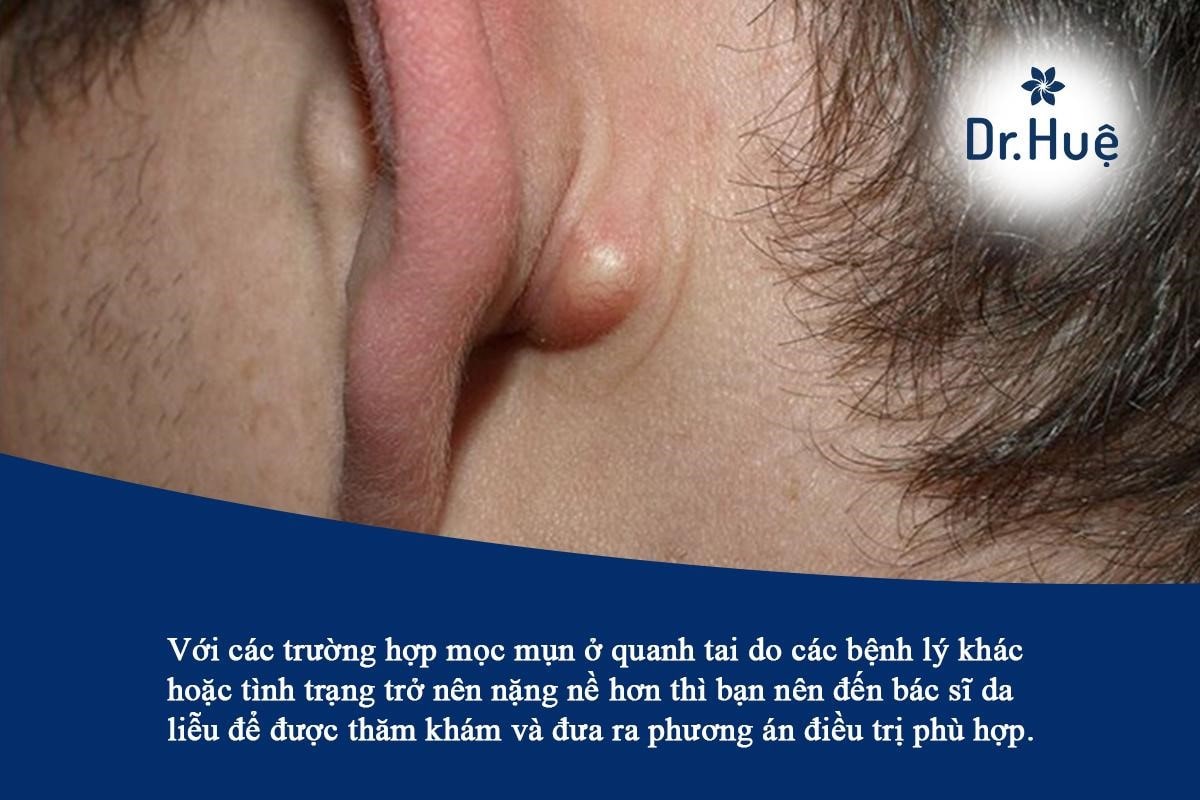Bị mọc mụn ở sau vành tai và trong lỗ tai nên chữa trị ra sao