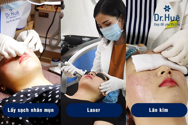 Dr. Huệ áp dụng nhiều phương pháp trị mụn cho da nhờn