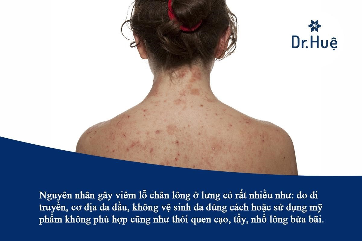 Những nguyên nhân dẫn đến bị viêm lỗ chân lông tại vùng lưng