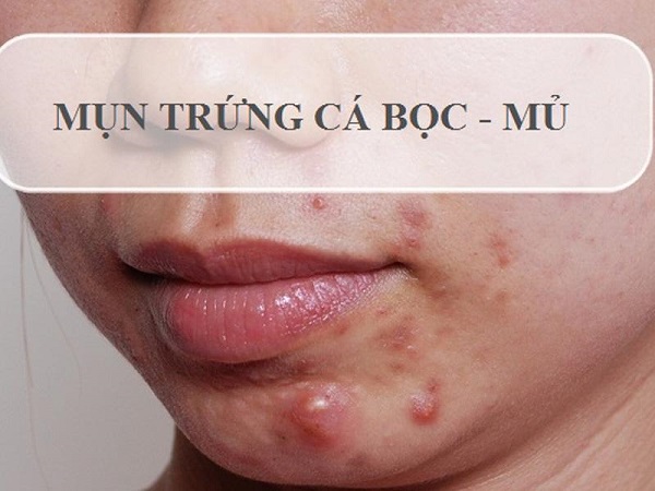 Mụn bọc là gì
