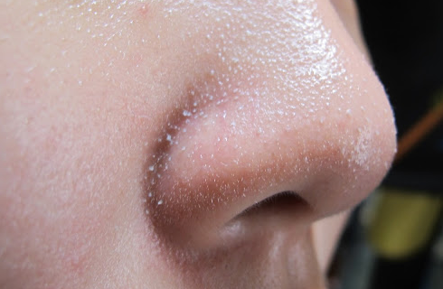 Mụn đầu trắng là gì