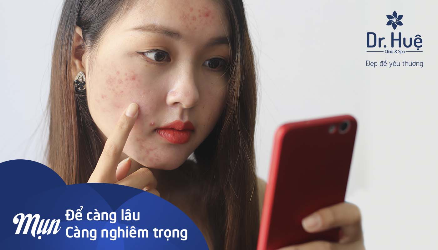 Mụn để càng lâu sẽ càng nghiêm trọng