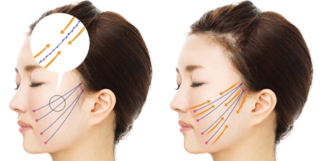 Cách phòng tránh các biến chứng nâng cơ mặt
