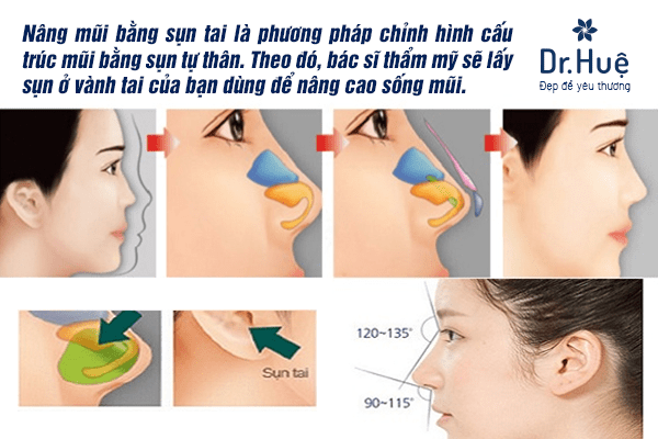 Nâng mũi bằng sụn tai là gì? 