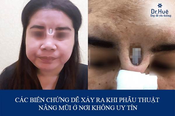 Nguyên nhân dẫn đến các biến chứng sau khi phẫu thuật nâng mũi không đúng nơi uy tín