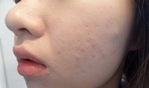 Nguyên nhân gây ra mụn đầu trắng