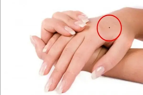 Nốt ruồi trên mu bàn tay phải phụ nữ có ý nghĩa gì?