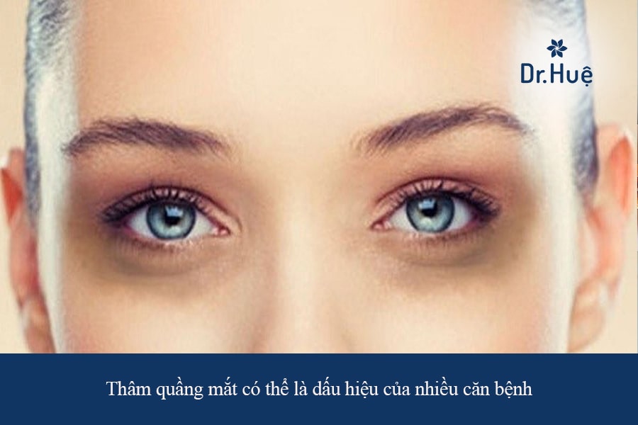 Quầng mắt bị thâm có thể là báo hiệu của các vấn đề sức khỏe 